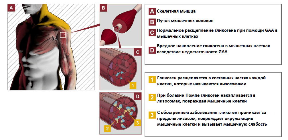 Болезнь помпе картинки